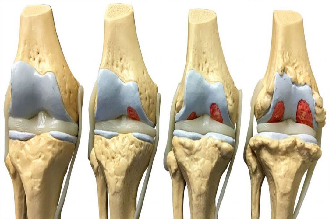 Osteoartrit gelişiminin aşamaları