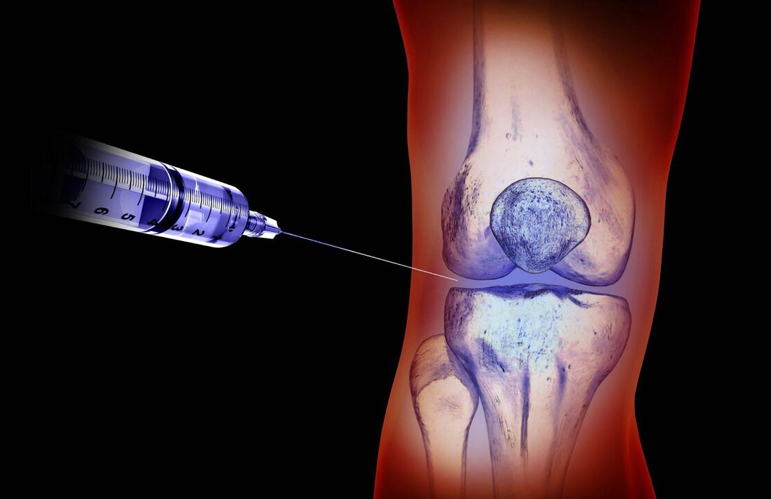 Osteoartrit için eklem içi enjeksiyonlar