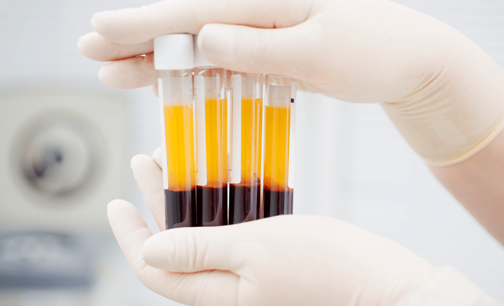 Osteoartrit için PRP tedavisi için trombosit açısından zengin plazma